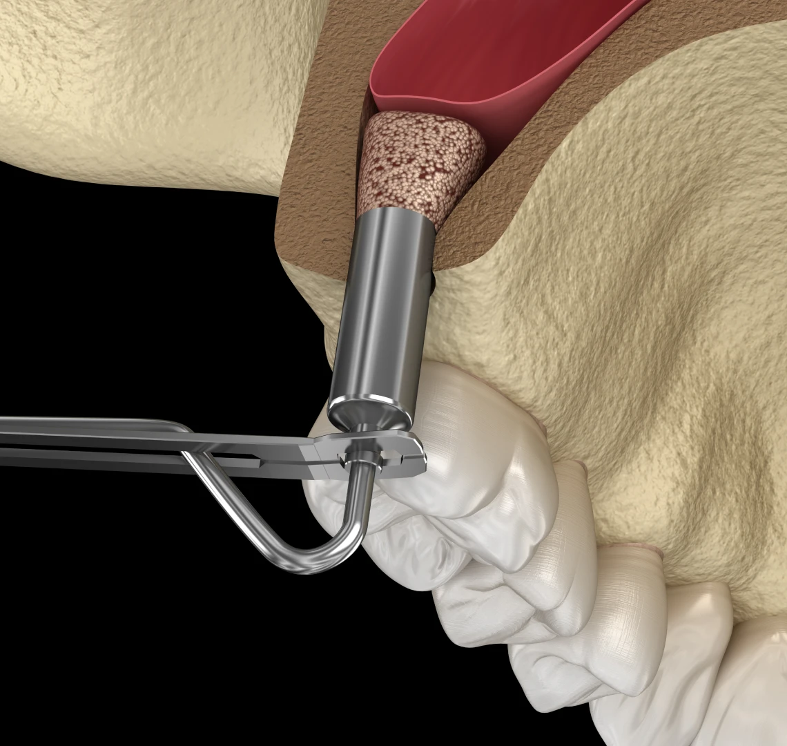 Sinus lift au cabinet du Dr Maha BENNANI RIBET à Menton