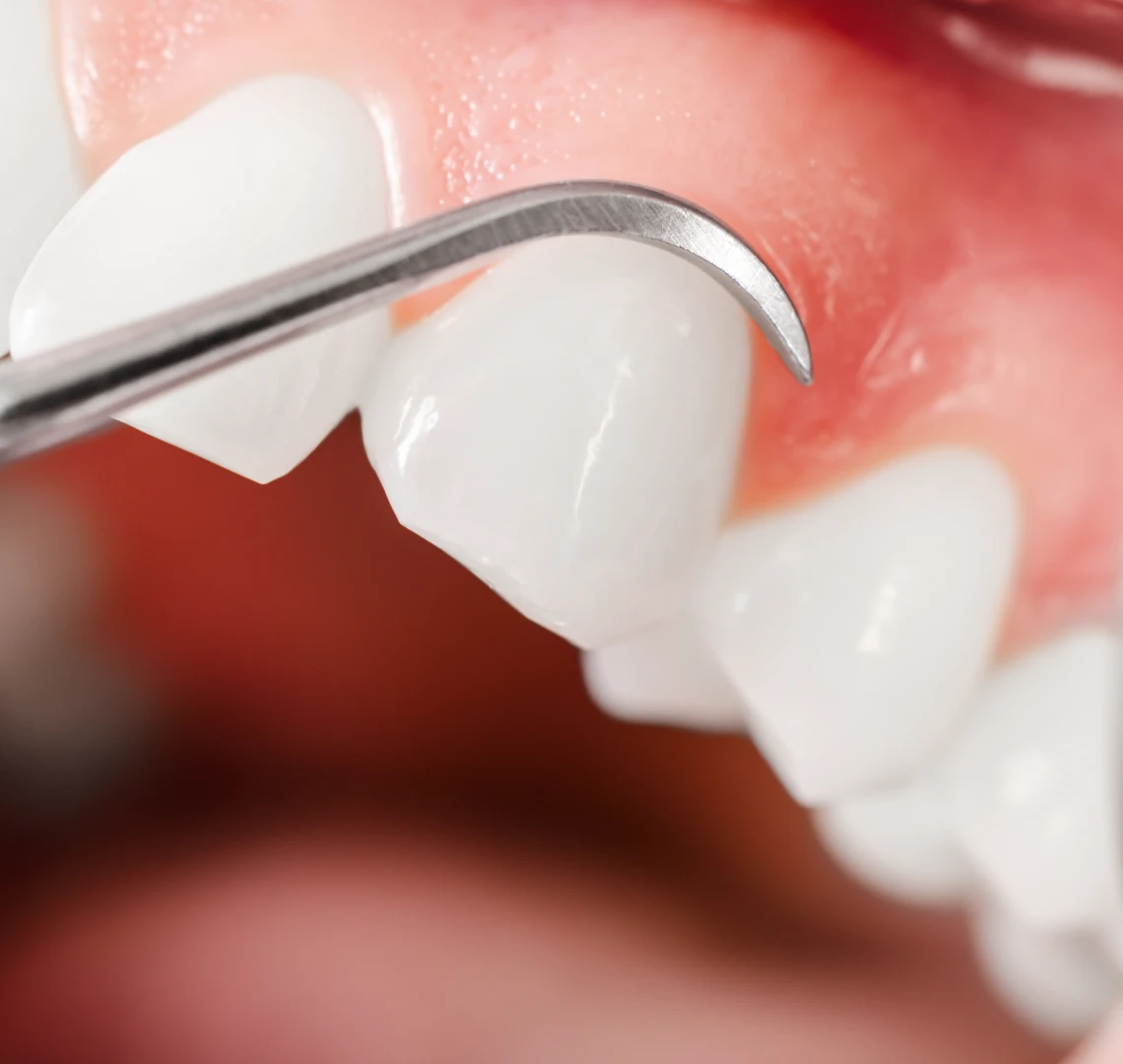 Assainissement parodontal chirurgical au cabinet du Dr Bennani Ribet à Menton