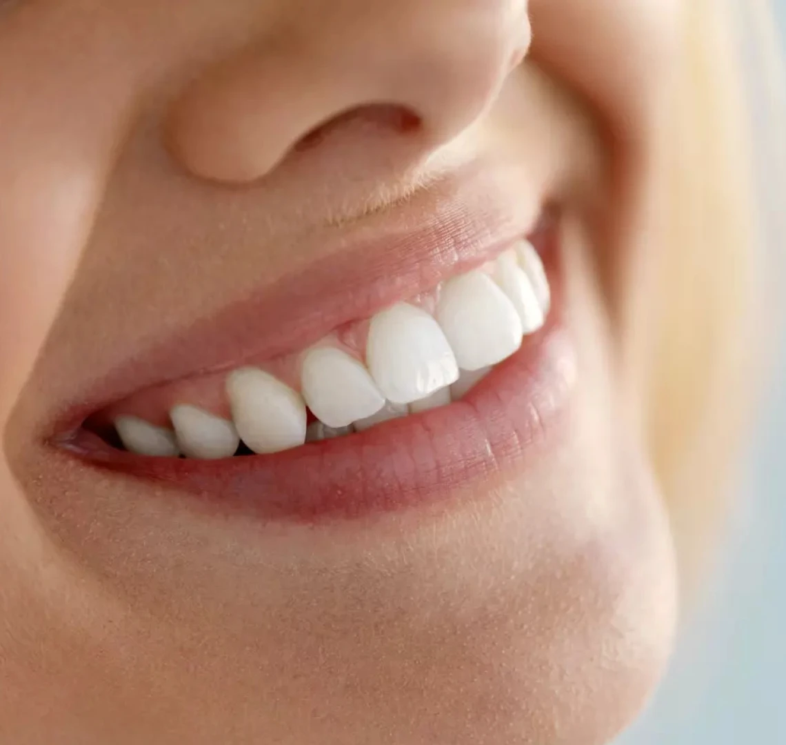 Blanchiment dentaire au cabinet du Dr Maha BENNANI RIBET à Menton près de Monaco