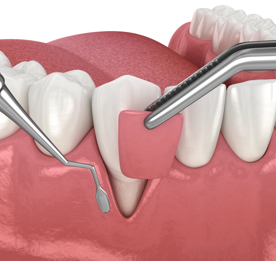 Greffe gingivale au cabinet du Dr Bennani Ribet à Menton