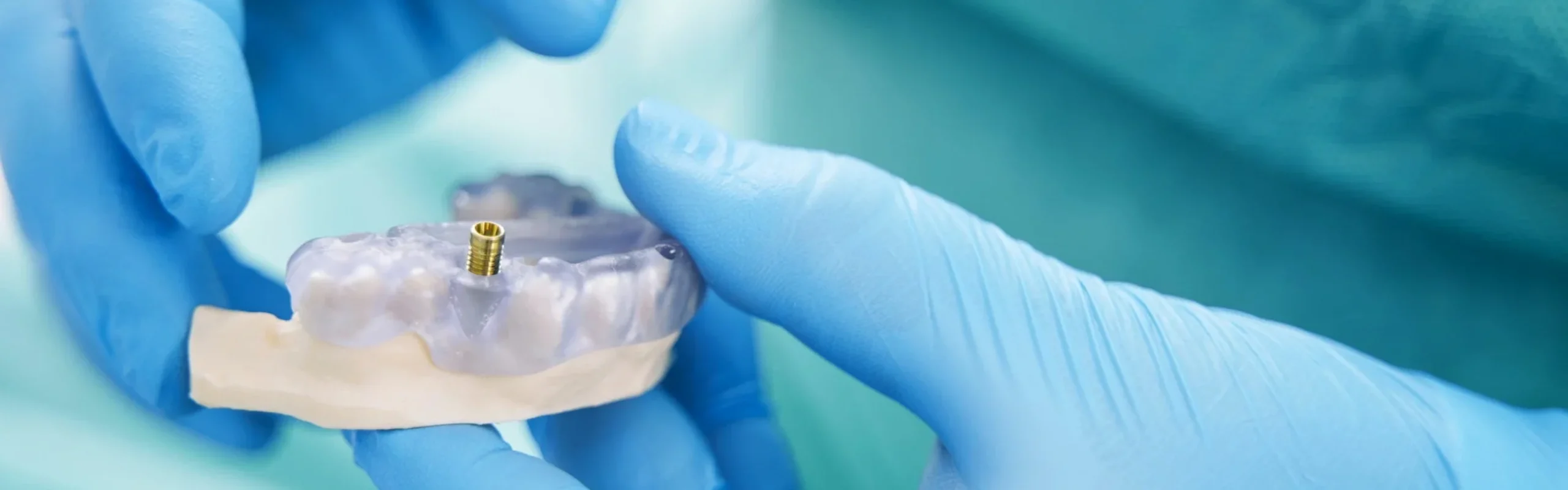 Guide de chirurgie imprimé en 3D au cabinet de parodontologie et d'implantologie du Dr Bennani Ribet à Menton