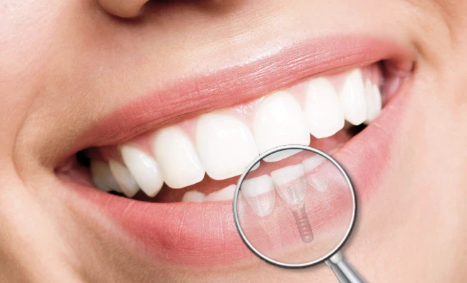 Tout savoir sur les implants dentaires : le cabinet de parodontologie et d'implantologie du Dr Bennani Ribet à Menton, proche Monaco