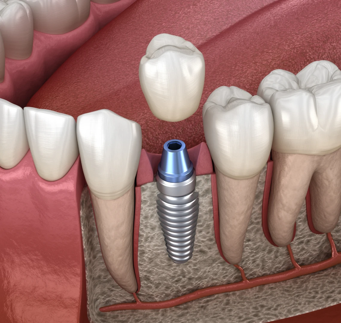 Implantologie par Dr Bennani à Menton proche de Monaco
