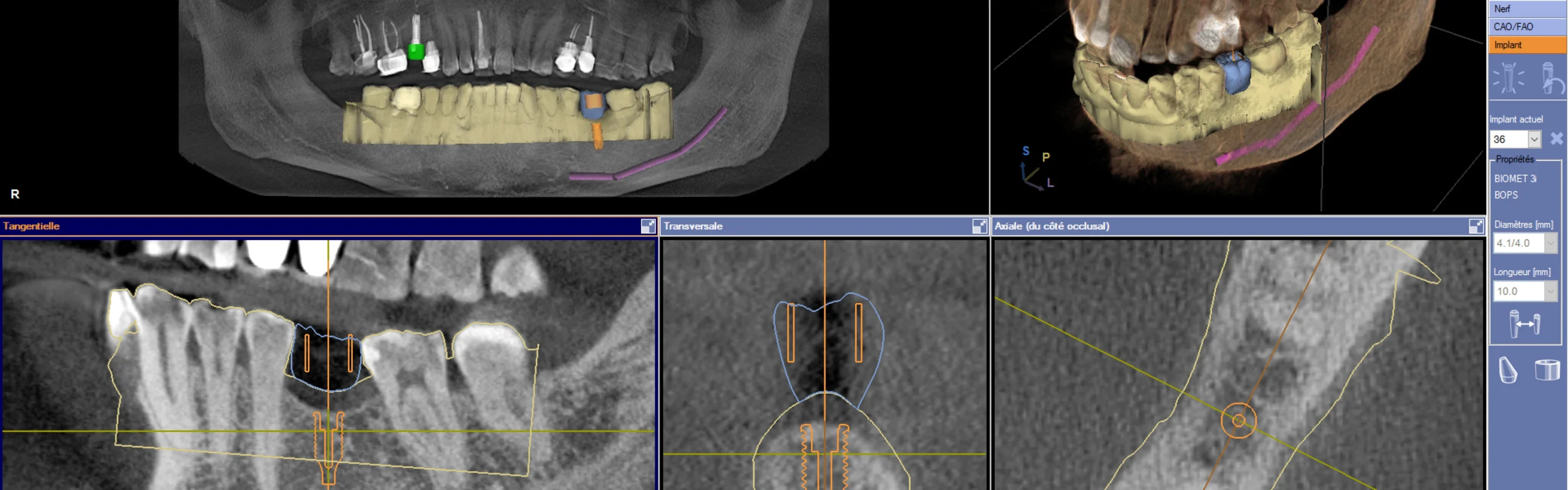 Planification sur ordinateur : implantologie au cabinet du Dr Bennani Ribet situé à Menton